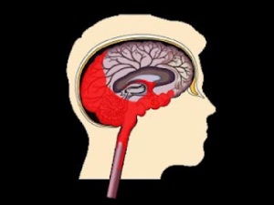 المخ و الخلايا الميته